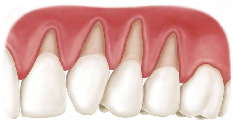 Retração Gengival
