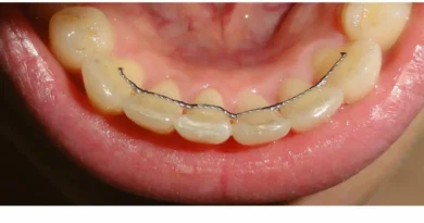 contenção ortodontica