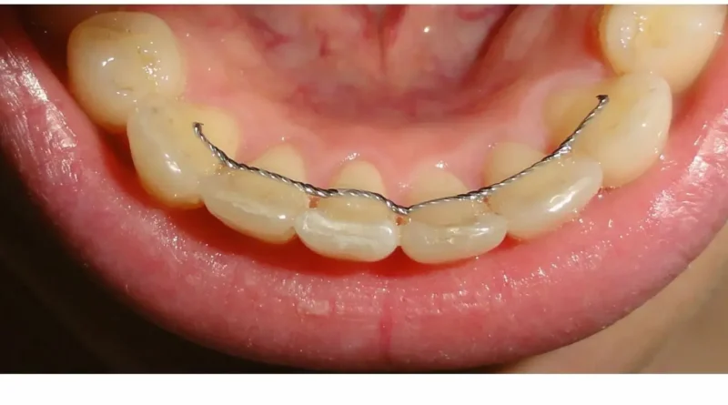 contenção ortodontica